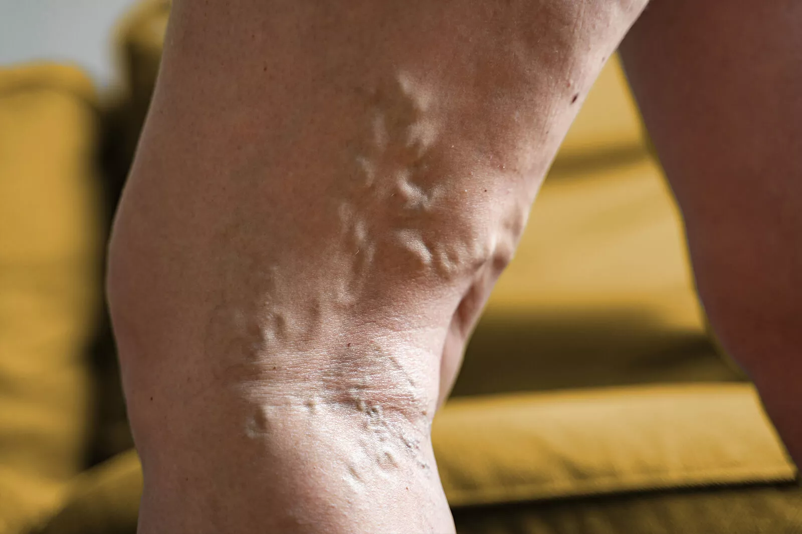Delve into how genetic predispositions contribute to venous diseases like varicose veins and deep vein thrombosis, and understand the implications for diagnosis and treatment.​