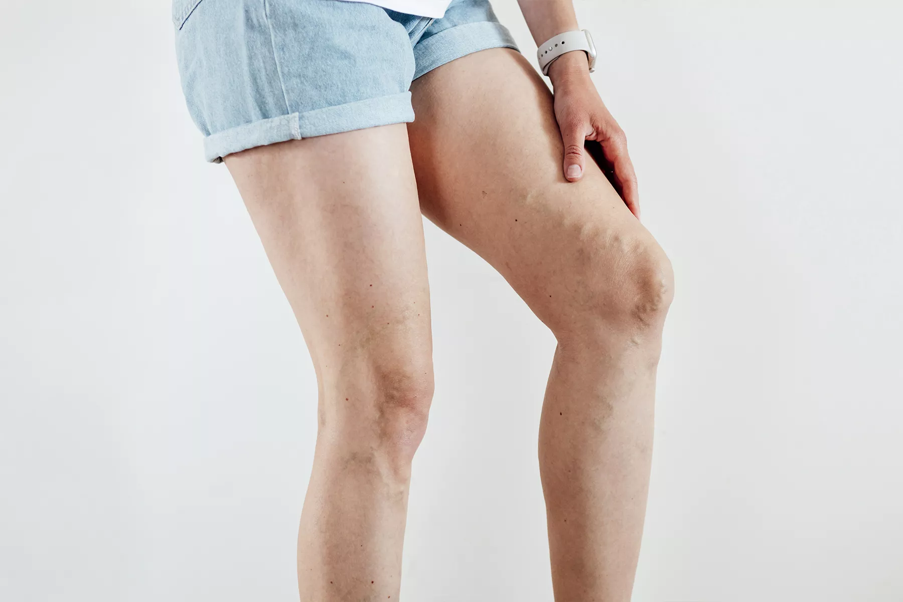 Learn about the clinical stages of varicose veins from early spider veins to advanced venous ulcers, plus treatment options for each stage and prevention strategies for healthier legs.